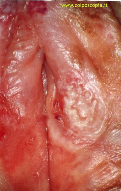 Carcinoma vulvare