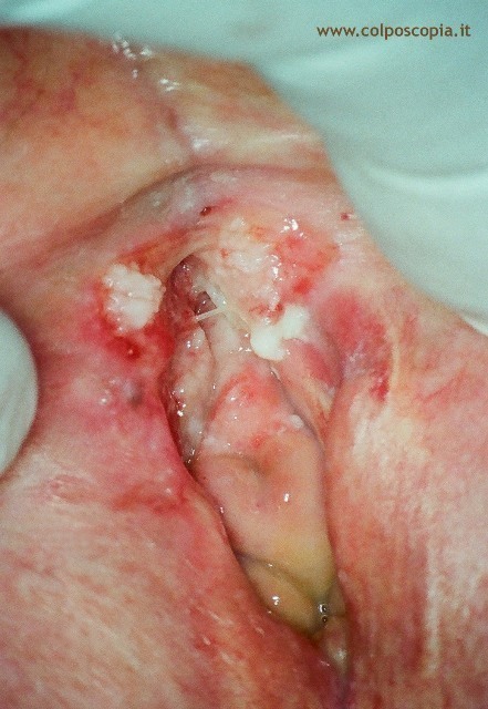 Carcinoma vulvare